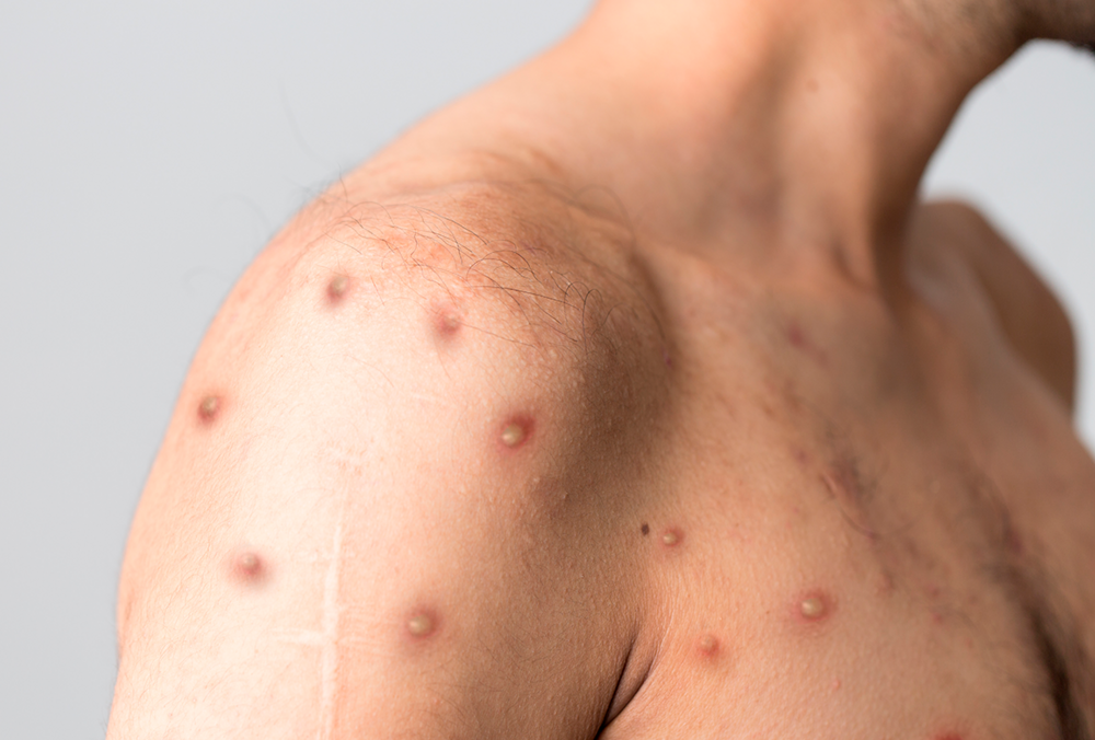 В Европе возросло количество смертельных случаев обезьяньей оспы