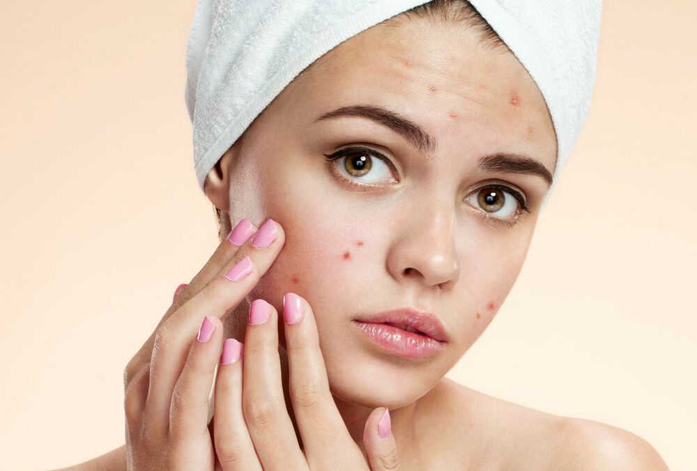 Нутриціолог назвала продукти, які можуть спровокувати появу акне
