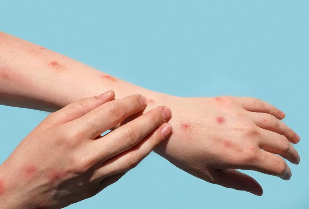 В Украине зафиксировали первый случай заражения оспой обезьян