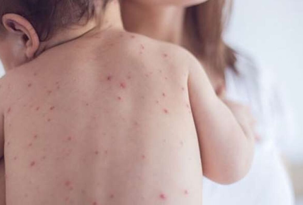 В Україні підтвердили два випадки кору