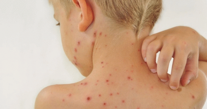 В Европе зафиксировали первую смерть от обезьяньей оспы