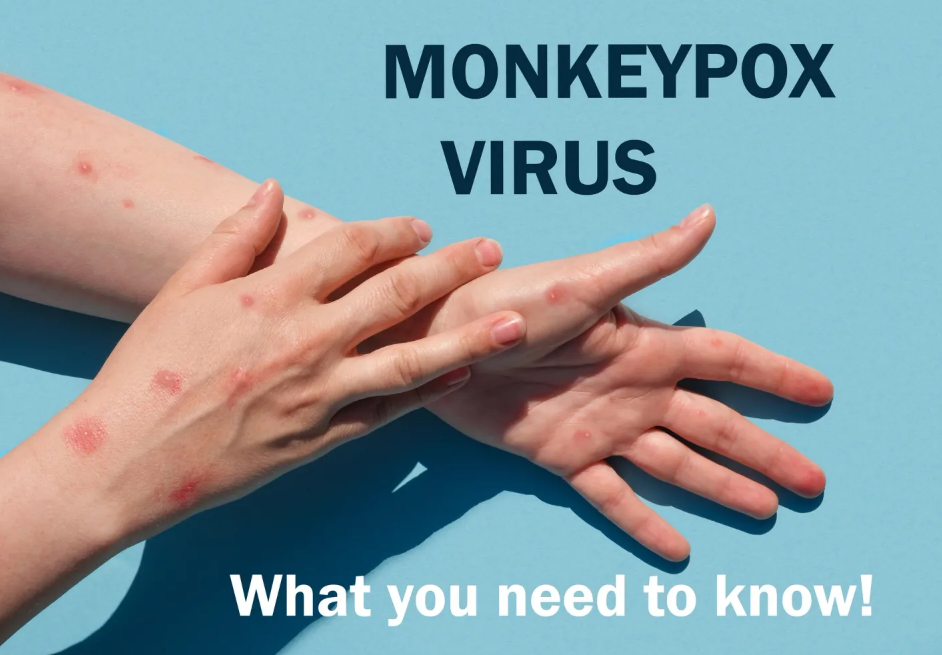 Чи є в Україні випадки віспи мавп