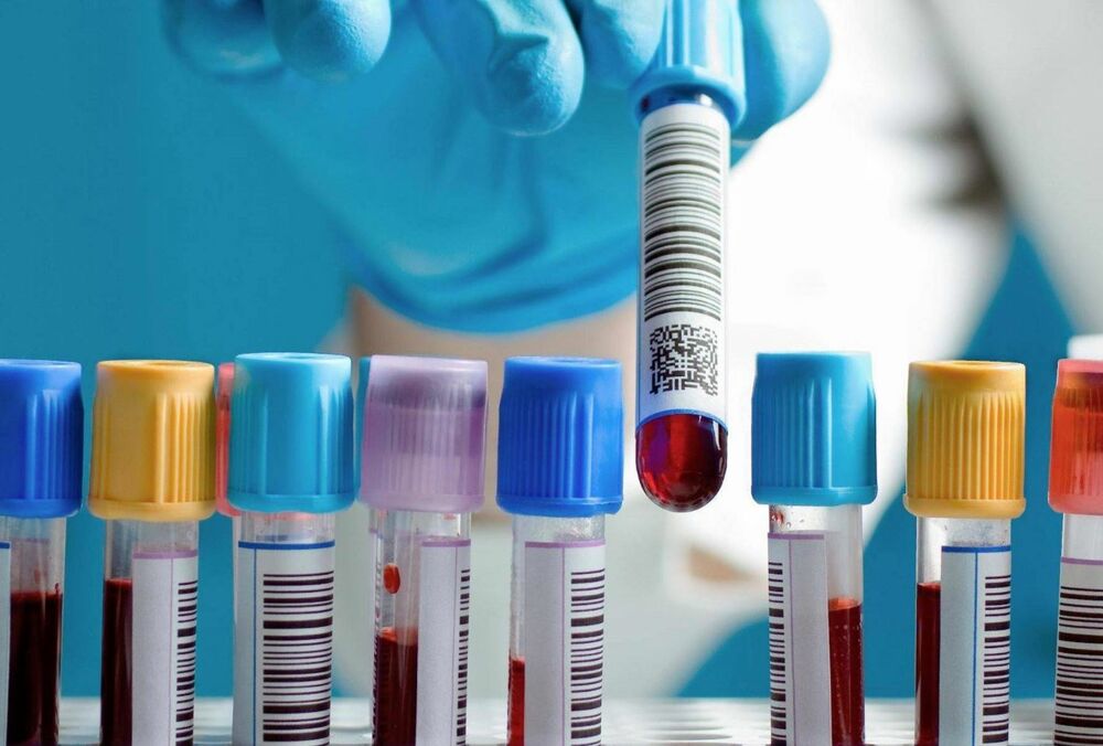 Ученые разработали анализ крови, который может предсказать развитие шизофрении