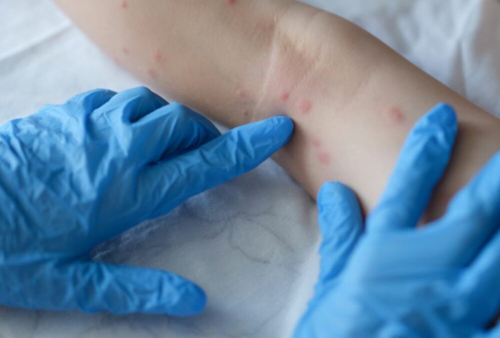 Лікарі в Британії виявили ще два випадки нового штаму мавпячої віспи