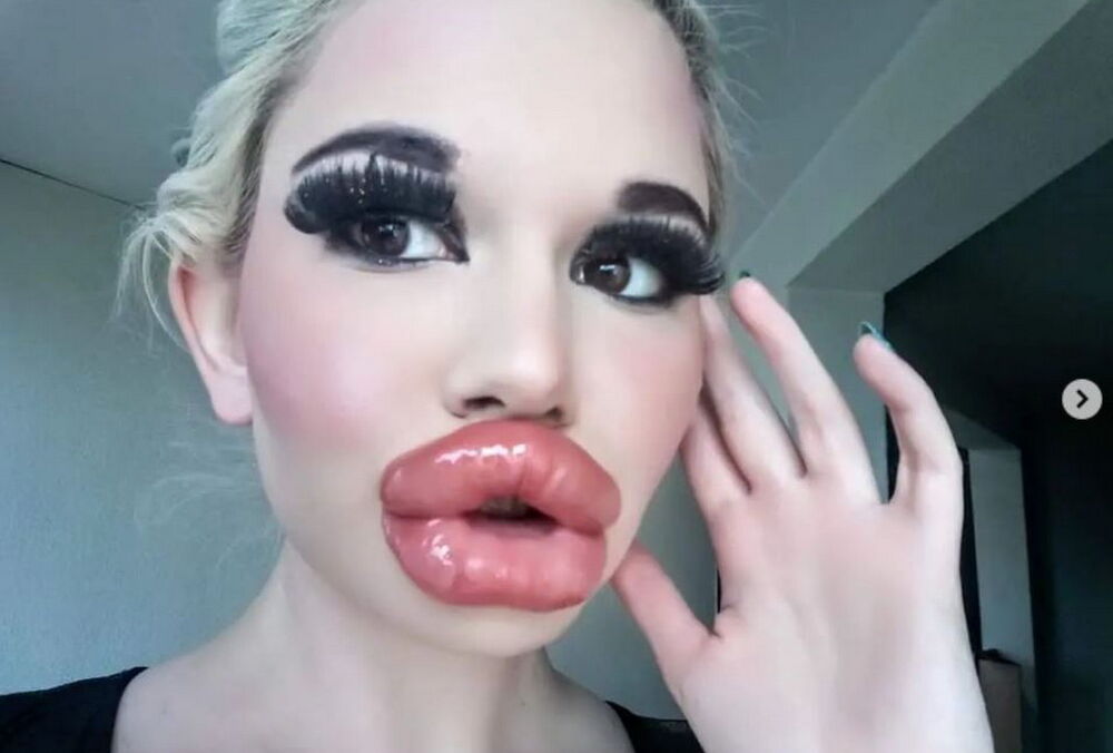 Дівчина витратила 10 тисяч доларів на найбільші губи у світі – ось, що з цього вийшло (фото)