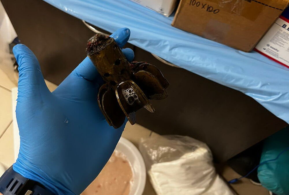 Врачи достали из тела военного хвостовик мины - саперы разрешили (фото)