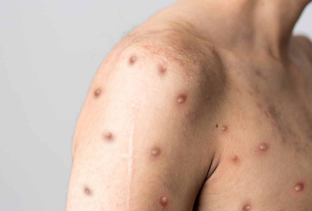 Власти США объявили чрезвычайную ситуацию из-за вспышки оспы обезьян 