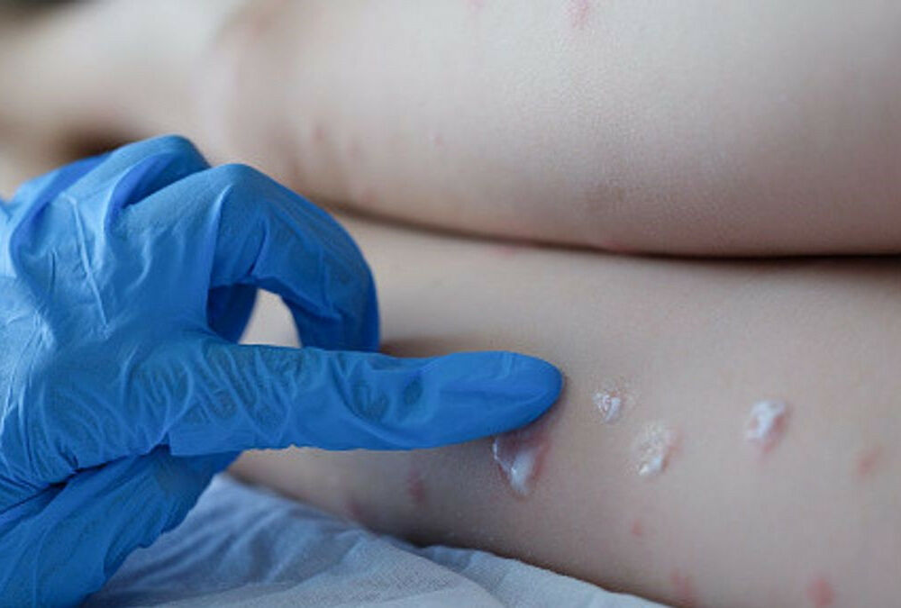 В Украине обнаружили третий случай обезьяньей оспы