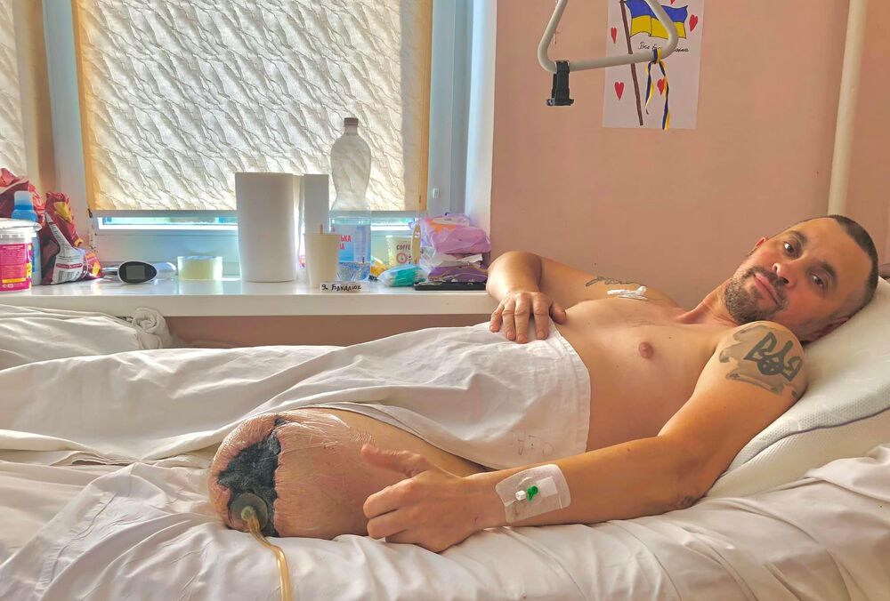 Поранення та ампутація: як бійці починають жити заново