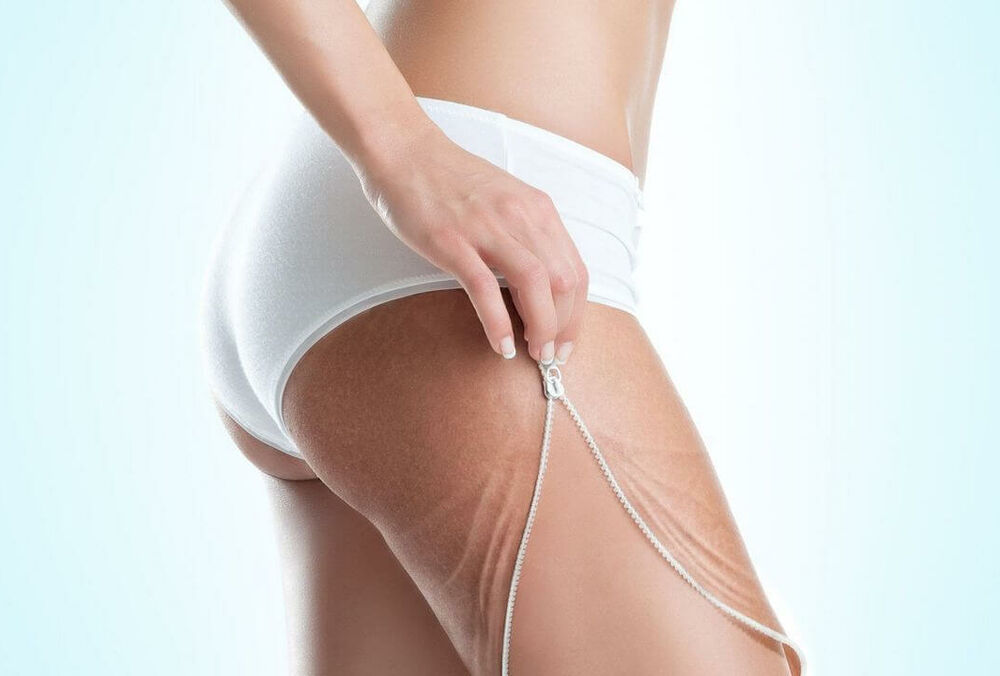 Самые эффективные антицеллюлитные обертывания