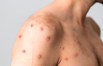 В Европе возросло количество смертельных случаев обезьяньей оспы В Европе возросло количество смертельных случаев обезьяньей оспы