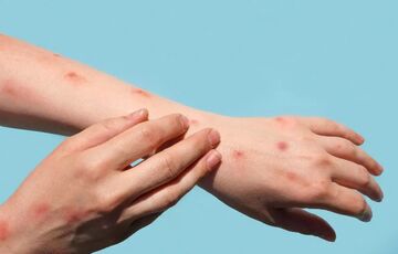 В Украине зафиксировали первый случай заражения оспой обезьян