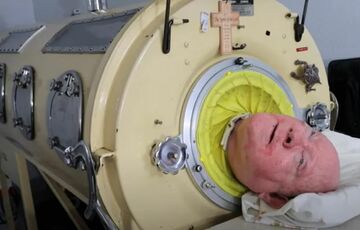 Помер Пол Александер - людина, яка 70 років прожила в капсулі ”залізні легені”