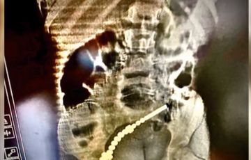 Во Львове девочка чуть не погибла из-за популярной игрушки, - ВИДЕО