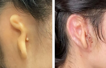 Врачи впервые пересадили человеку напечатанное на 3D-принтере ухо