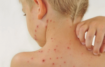 В Европе зафиксировали первую смерть от обезьяньей оспы В Европе зафиксировали первую смерть от обезьяньей оспы