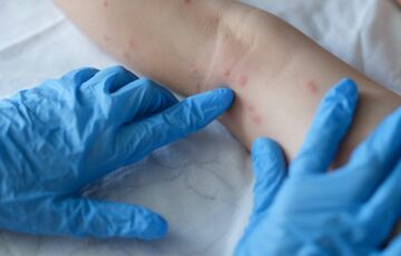 Лікарі в Британії виявили ще два випадки нового штаму мавпячої віспи