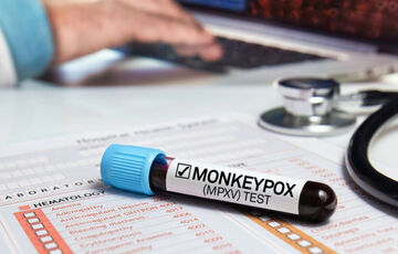 Мавпяча віспа: чи є в Україні вакцини