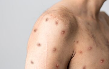 Власти США объявили чрезвычайную ситуацию из-за вспышки оспы обезьян 