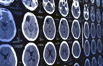 В Индии пациент играл на пианино во время операции на мозге, - ВИДЕО