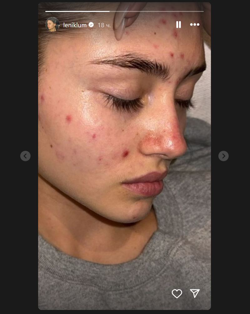 Дочь супермодели Хайди Клум показала откровенное фото своей неидеальной кожи — фото