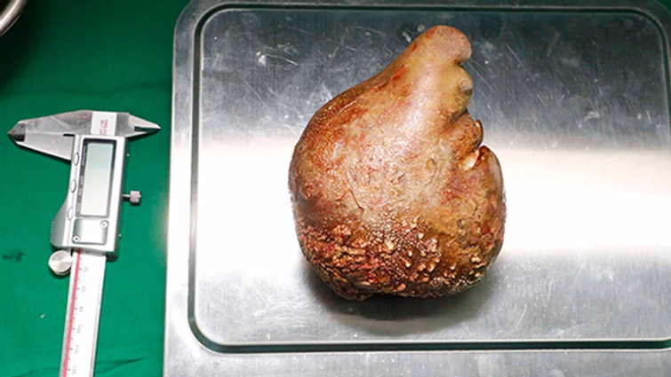Найбільший у світі камінь у нирці видалили пацієнтові зі Шрі-Ланки, його внесли до Книги рекордів Гіннеса — фото